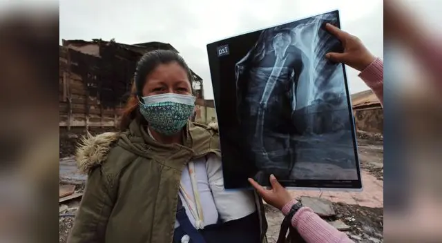 Mujer que rescató a su hijo del incendio pide ayuda para operarse el brazo Mujer que rescató a su hijo del incendio pide ayuda para operarse el brazo