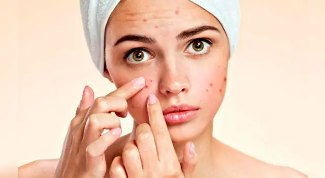 Conoce AQUÍ como cuidarse y prevenir el acné. Conoce AQUÍ como cuidarse y prevenir el acné.