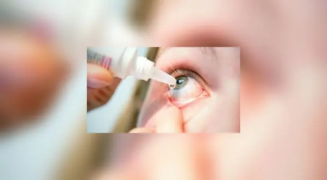 La conjuntivitis por causas irritativas se produce por una inflamación del borde palpebral (blefaritis).
