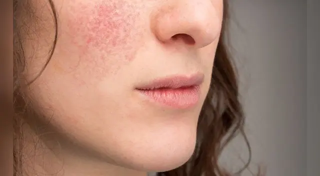 La piel de la cara y del cuerpo se pone muy seca e irritable. La piel de la cara y del cuerpo se pone muy seca e irritable.