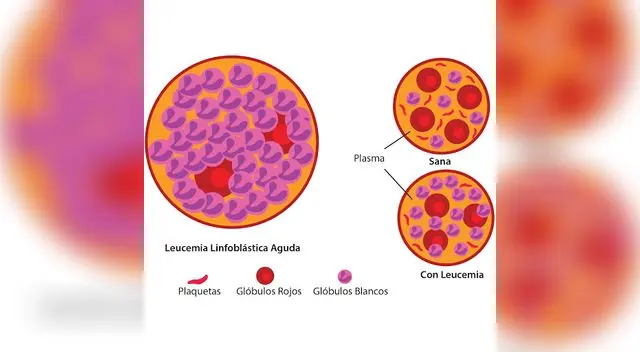 Las leucemias se dividen en dos tipos principales: Aguda (que progresa rápidamente).