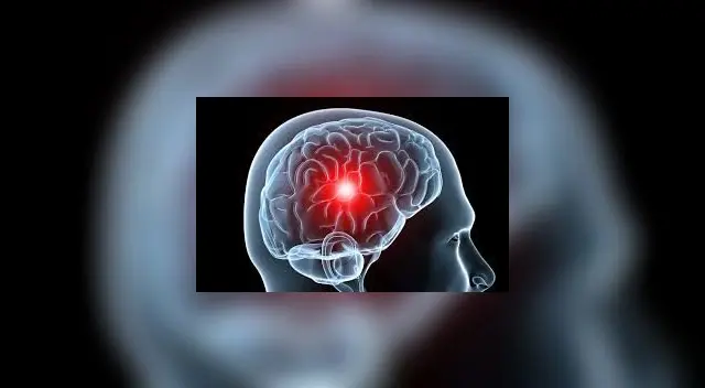 Los medicamentos preventivos y analgésicos pueden controlar las migrañas.