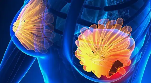 Si notas un bulto en la mama ve inmediatamente a hacerte un despistaje. Si notas un bulto en la mama ve inmediatamente a hacerte un despistaje.