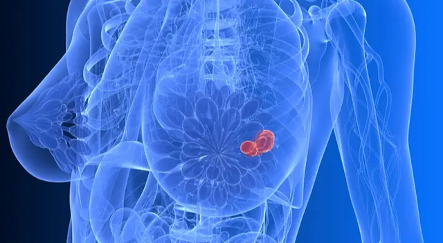 El autoexamen no puede detectar lesiones pequeñas porque estas se ocultan en el tejido mamario y el tacto no puede identificarla. El autoexamen no puede detectar lesiones pequeñas porque estas se ocultan en el tejido mamario y el tacto no puede identificarla.