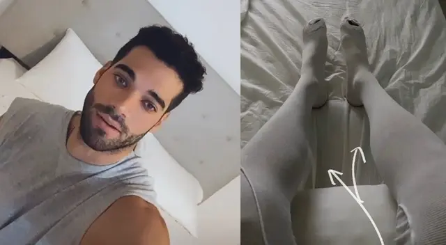 Guty Carrera habló sobre la operación a sus pantorillas Guty Carrera habló sobre la operación a sus pantorillas