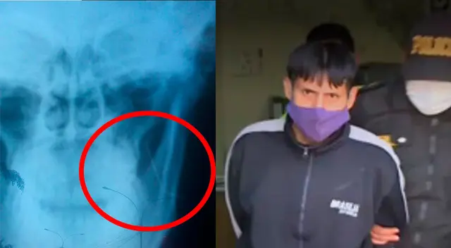 Sujeto incrusta una jeringa en el rostro de una mujer Sujeto incrusta una jeringa en el rostro de una mujer