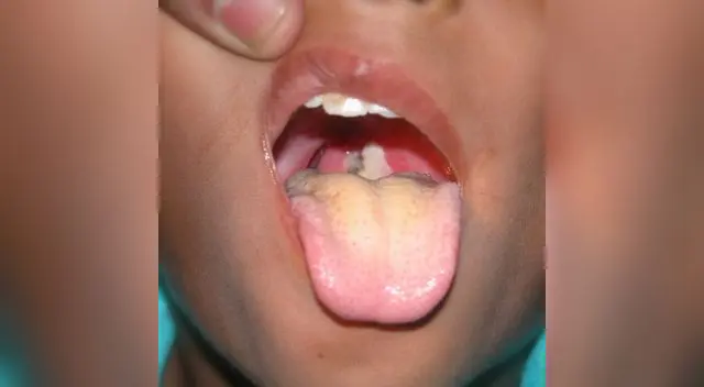 La bacteria infecta más comúnmente la nariz y la garganta.