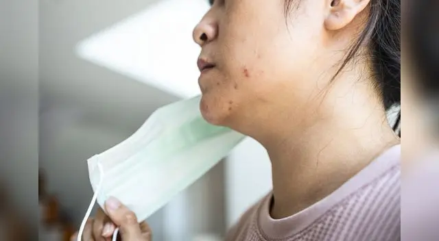 La mascarilla puede causar problemas en la piel como la dermatitis atópica.