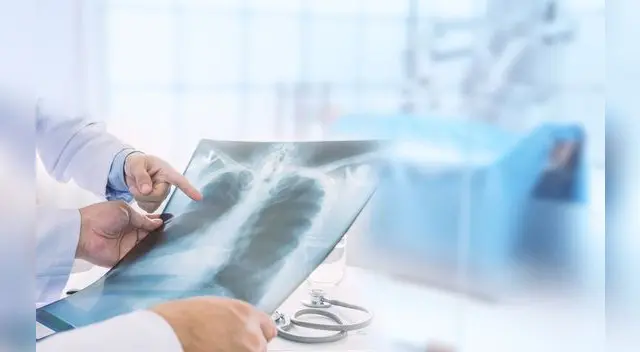 La neumonía puede provocar que los sacos de aire se llenen de fluido o pus. La neumonía puede provocar que los sacos de aire se llenen de fluido o pus.