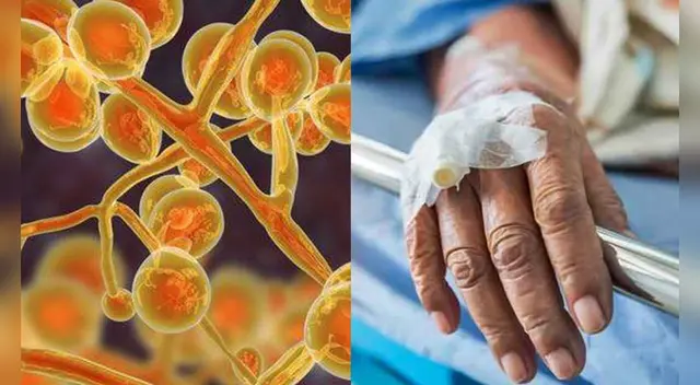 La infección por candida auris es poco frecuente en las personas saludables. La infección por candida auris es poco frecuente en las personas saludables.