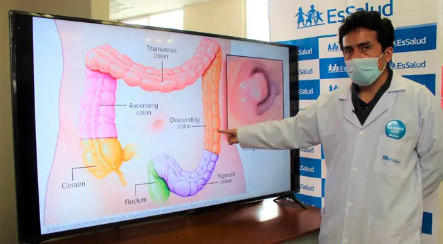 Incremento de cáncer de colon en pandemia.