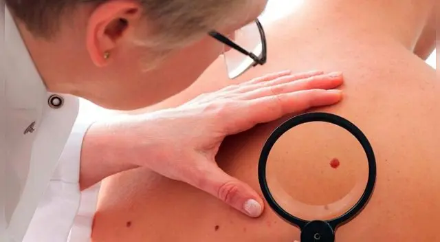 Si tu lunar cambia de tamaño, grosor y color deberías realizarte un despistaje.