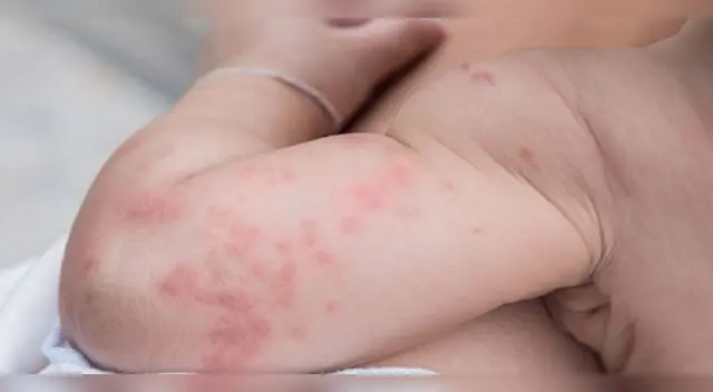 Recomiendan usar ropa suelta para evitar casos de sarpullido Recomiendan usar ropa suelta para evitar casos de sarpullido