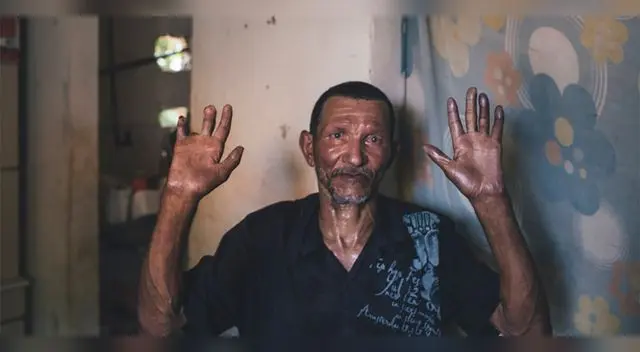 Aún la lepra se mantiene presente en la Amazonía peruana, en específico, en la región de Ucayali.