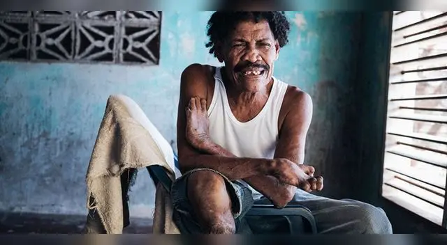 La enfermedad histórica de la lepra, que incluso está descrita como una maldición divina en la Biblia cristiana.