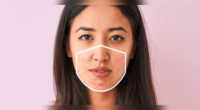 Nariz, mentón y mejillas son las zonas más afectadas.