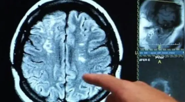 ¿Cuál sería el factor que provoca la 'niebla cerebral' por la COVID-19? Esto dicen los expertos.