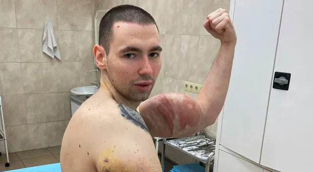 Kirill Tereshin enfrentó una peligrosa cirugía para que no le amputen el brazo