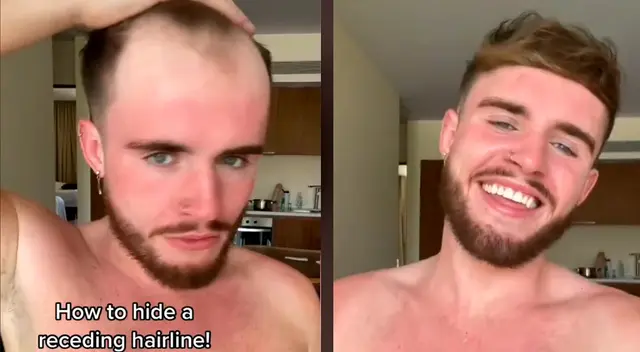 “Me encanta que hables de esto. La mayoría de la gente lo esconde y es muy común”, escribió un usuario de TikTok.