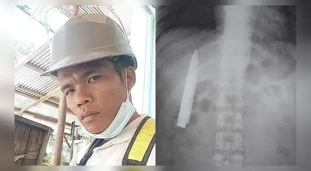 El hombre se enteró que tenía un objeto punzocortante cuando acudió a realizarse una prueba de rayos X. El hombre se enteró que tenía un objeto punzocortante cuando acudió a realizarse una prueba de rayos X.