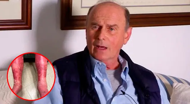 Richard Terrell, de 74 años, recibió su vacuna el pasado 6 de marzo y comenzó a sufrir reacciones cutáneas después de cuatro días. Richard Terrell, de 74 años, recibió su vacuna el pasado 6 de marzo y comenzó a sufrir reacciones cutáneas después de cuatro días.