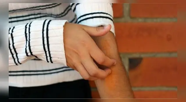 Coronavirus: estudio revela que lesiones en la piel pueden ser síntomas de la enfermedad.