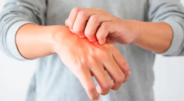 Las manifestaciones cutáneas del coronavirus en general duran de 5 a 14 días.