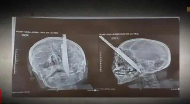 La víctima tuvo que ser trasladada a Lima dada la gravedad del ataque, donde fue operado, pero lastimosamente perdió el ojo izquierdo.