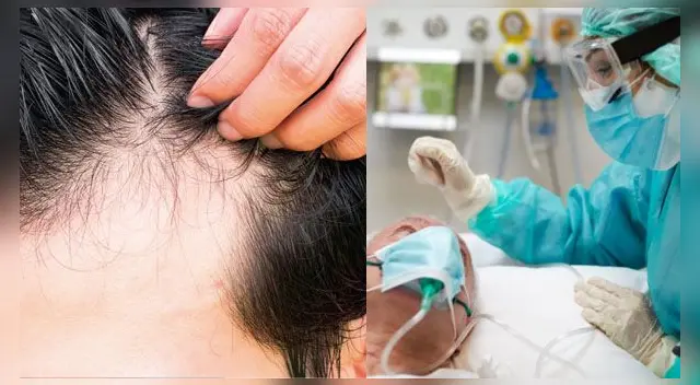EE. UU.: científicos hallan una relación entre la calvicie masculina y los riesgos de tener COVID-19 severo. EE. UU.: científicos hallan una relación entre la calvicie masculina y los riesgos de tener COVID-19 severo.