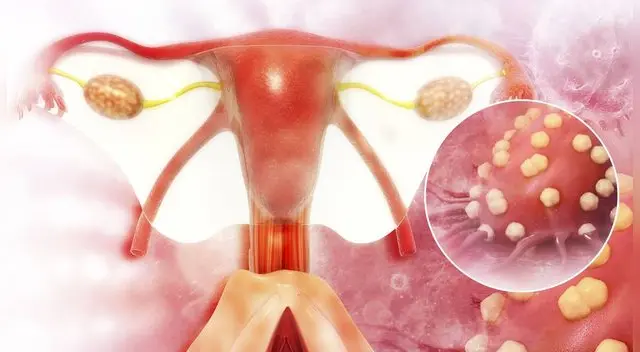 Es importante realizarse chequeos anuales y oportunos cuando se sienta alguna molestia antes de que se conviertan en cáncer.