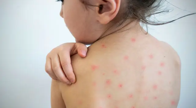 En algunos casos presentan complicaciones graves que podrían desencadenar en una neumonía, encefalitis o en el peor de los casos generar la muerte.