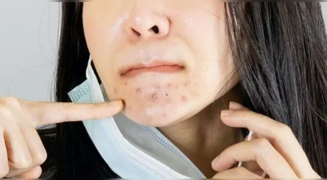 Especialista recomienda hidratar la piel luego del uso de la mascarilla.