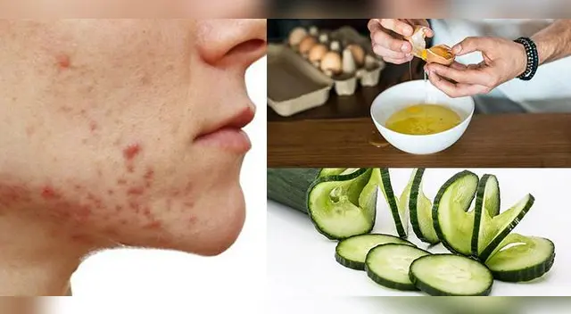 Cómo quitar barros y espinillas de la cara con remedios caseros.