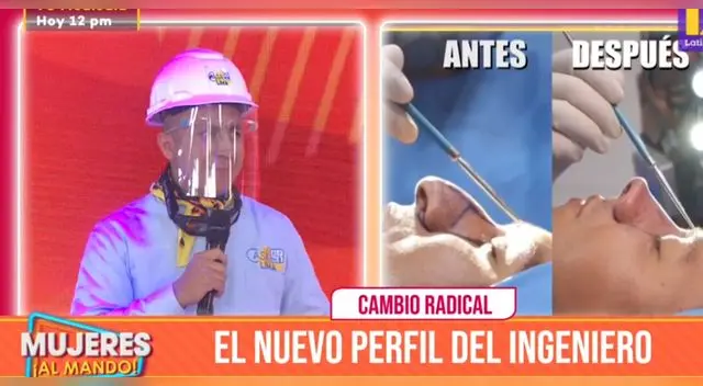 El ingeniero bailarín se sometió a una rinoplastia. El ingeniero bailarín se sometió a una rinoplastia.