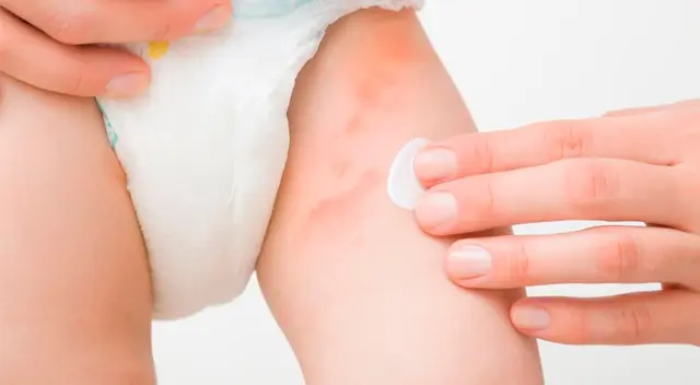 En la piel también se forman puntitos rojos y pequeños granitos blancos. En la piel también se forman puntitos rojos y pequeños granitos blancos.