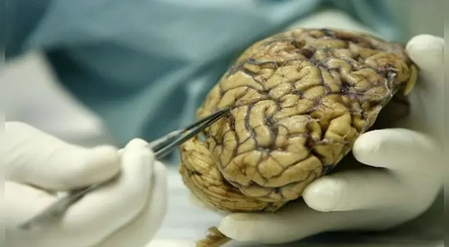 Esta patología ha sido detectado en persona entre 18 y 85 años sin distinción de sexo entre los afectados. Esta patología ha sido detectado en persona entre 18 y 85 años sin distinción de sexo entre los afectados.