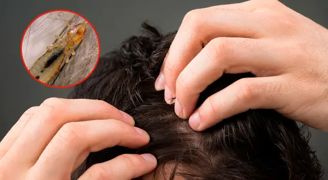 Conoce el significado de soñar con piojos blancos Conoce el significado de soñar con piojos blancos