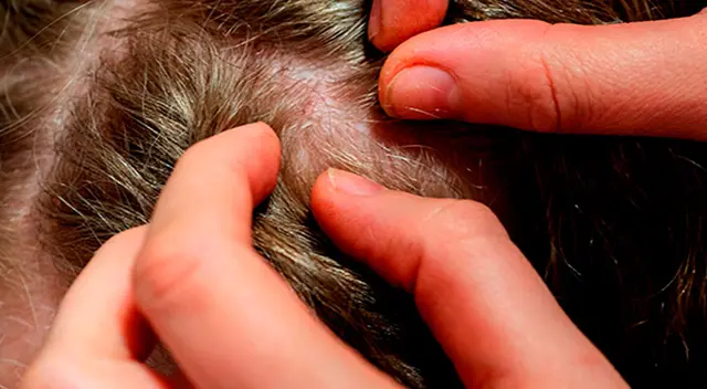 ¿Qué significa soñar que mato piojos? ¿Qué significa soñar que mato piojos?