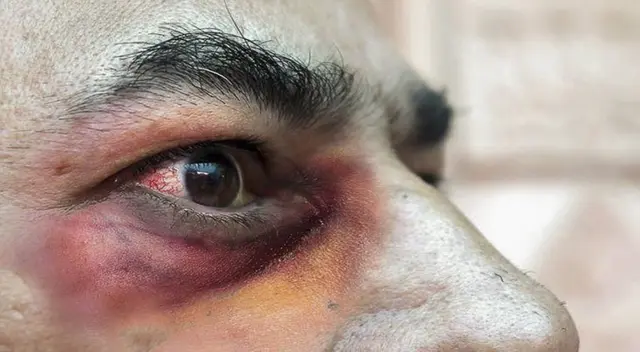 El hongo negro ataca a personas que están en recuperación o se han recuperado del coronavirus. El hongo negro ataca a personas que están en recuperación o se han recuperado del coronavirus.