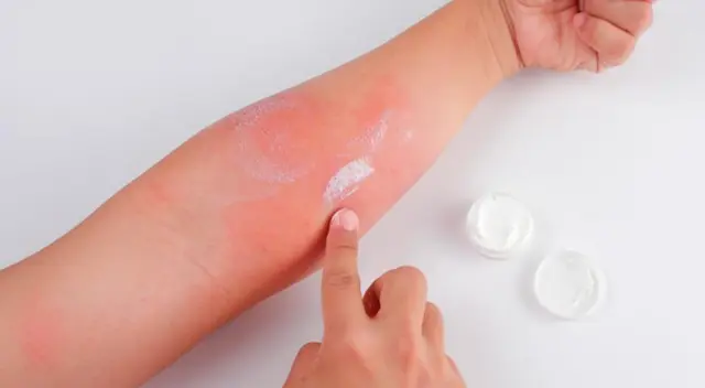 El frío y la humedad pueden causar lesiones en la piel y empeorar las alergias. El frío y la humedad pueden causar lesiones en la piel y empeorar las alergias.