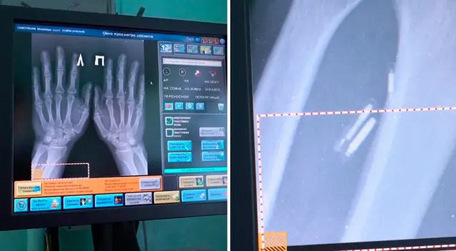 Alexandr Vólchek se colocó el primer dispositivo de este tipo debajo de la piel. Alexandr Vólchek se colocó el primer dispositivo de este tipo debajo de la piel.