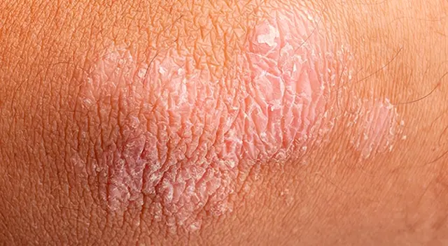 Muchas personas con predisposición a la psoriasis pueden estar libres de síntomas durante años. Muchas personas con predisposición a la psoriasis pueden estar libres de síntomas durante años.