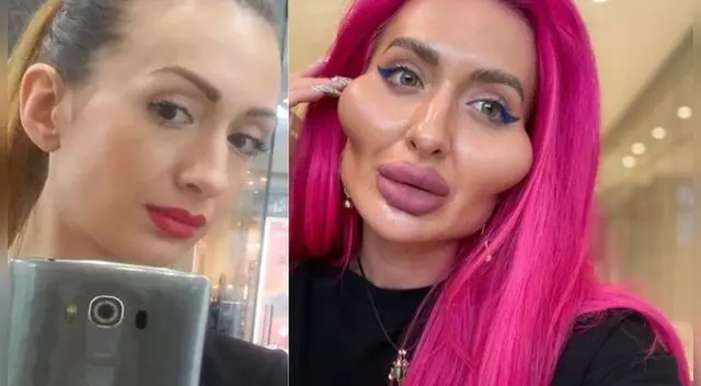 Mujer gasta miles de dólares en cirugías para tener las mejillas más grandes del mundo. Mujer gasta miles de dólares en cirugías para tener las mejillas más grandes del mundo.