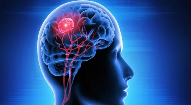Tumores cerebrales: ¿Son todos peligrosos?
