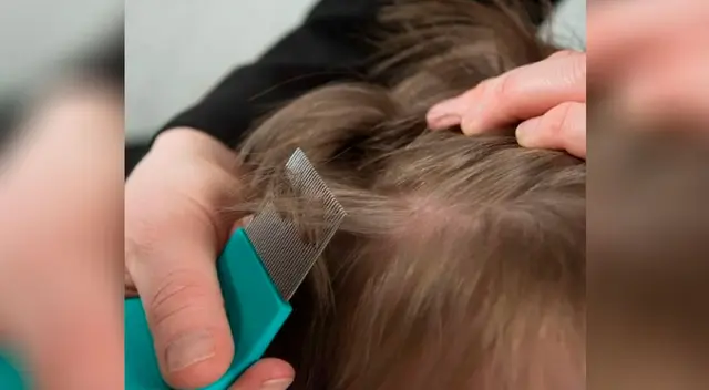 Significado de soñar con piojos en la cabeza de mi hija Significado de soñar con piojos en la cabeza de mi hija