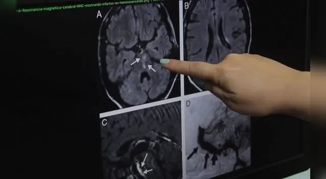 Aneurisma puede poner en riesgo vida de personas Aneurisma puede poner en riesgo vida de personas