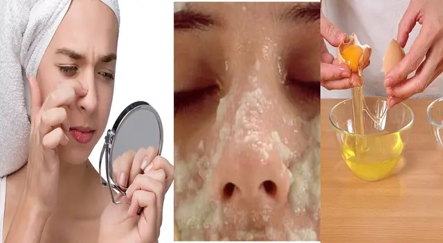 Te ostramos algunos remedios caseros para eliminar puntos negros de la cara.