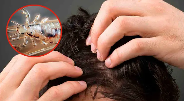 Significado de soñar con piojos y matarlos. Significado de soñar con piojos y matarlos.