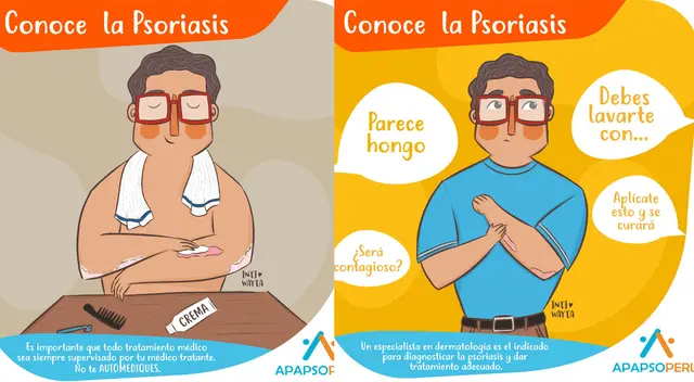 El 29 de octubre es el Día Mundial de la Psoriasis, enfermedad se da con más frecuencia entre los 15 y 30 años.