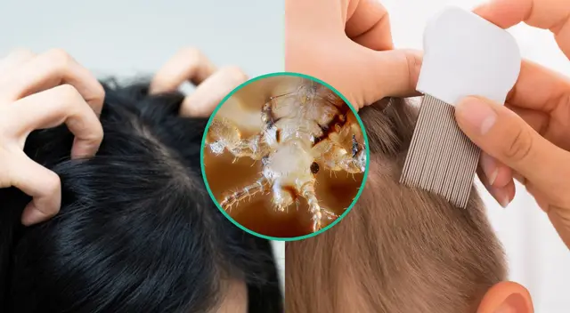 Los piojos se contagian fácilmente en espacios públicos.